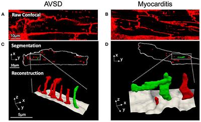 Severe T-System Remodeling in Pediatric Viral Myocarditis